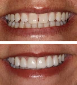 After Image: Porcelain Veneers and Nueromuscular Therapy