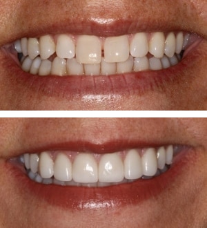 After Image: Porcelain Veneers and Nueromuscular Therapy - front