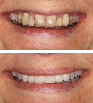 After Image: Replaced PFM Bridges - front