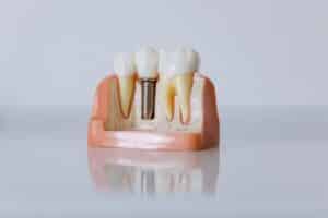 Dental implant