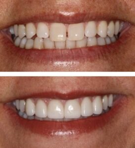 After Image: Porcelain Veneers and Neuromuscular Therapy